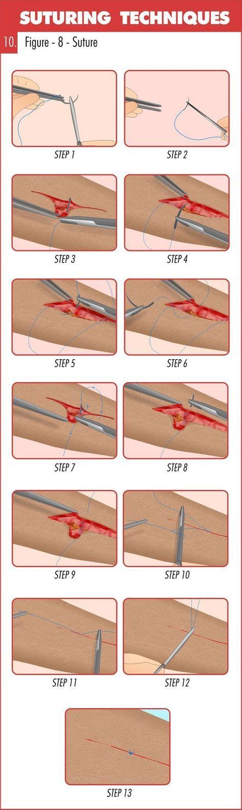 Complete Guide To Mastering Suturing Techniques Suturing Techniques