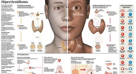 Hipertiroidismo Infografía Clínica Universidad De Navarra