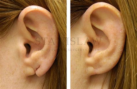 Earlobe Repair Gallery 6 Before And After Photos Connecticut