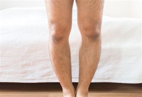 Rickets Overview Symptoms Causes Risk Factors And Treatment Factdr
