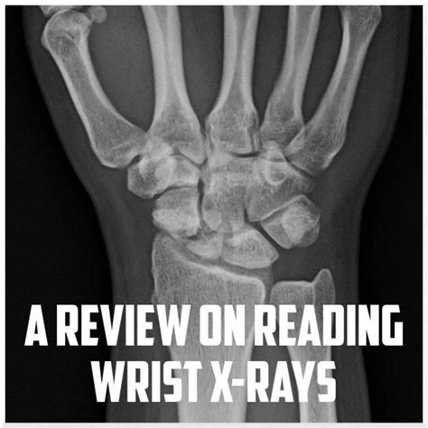 A Review On Reading Wrist X Rays Sports Medicine Review