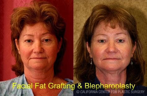 Patient 6746 Facial Fat Grafting Before And After Photos Encino