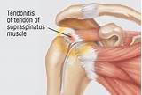 Medical Treatment For Tendonitis Images