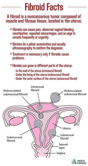 Difference Between Cyst And Fibroids Slidesharetrick