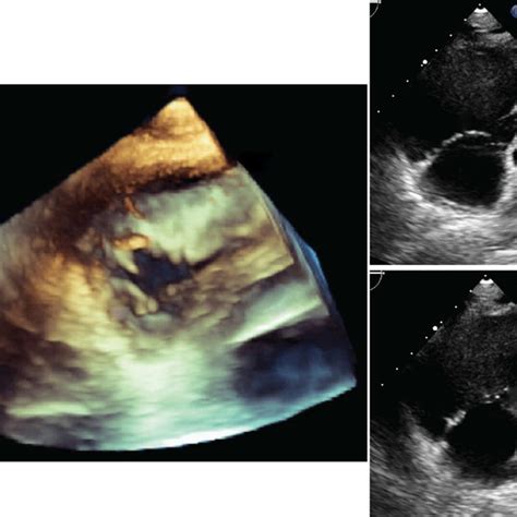 Tricuspid Annular Shape In Normal Versus Dilated Valves The Tricuspid