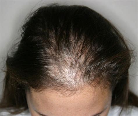 Read And Learn Two Spectacular Natural Treatments For Hair Loss