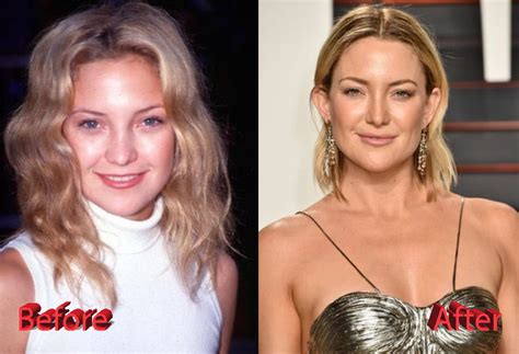 Kate Hudson Plastic Surgery A Surgery Gone Good