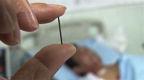 Docs Remove Acupuncture Needle Lodged In Chinese Mans Stomach For 40