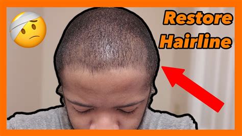 Thinning Hair For Black Men Youtube