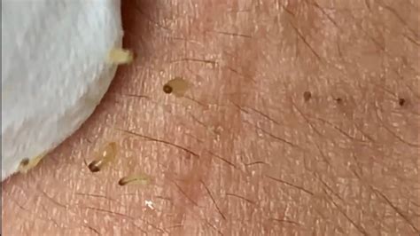 🔥 Pimple Popping 2020 Super Blackheads Extraction Blackheads Removal Acne Removalacne