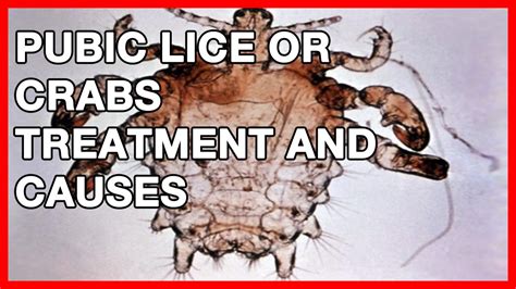 Pubic Lice Symptoms Diagnosis Treatment And Prevention Youtube