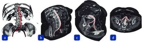 Bifurcation Of The Human Abdominal Aorta A Shows A 3d Direct Volume