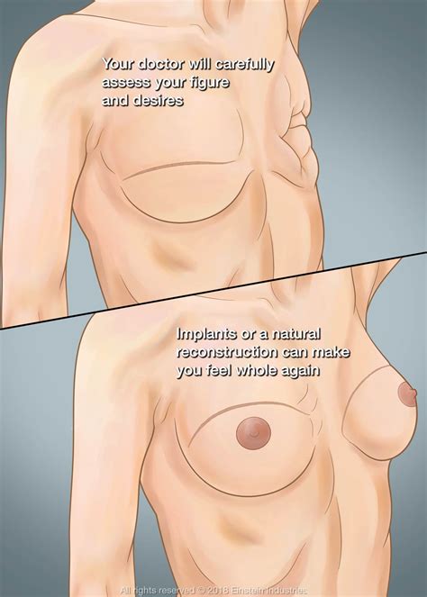 Breast Reconstruction After Radiation New Orleans La Ravi Tandon