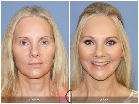 Facelift Forties Before And After Photos From Dr Kevin Sadati