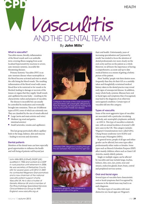 Pdf Vasculitis And The Dental Team