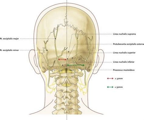 Occipital Nerve Occipital Nerve Block Occipital Nerve