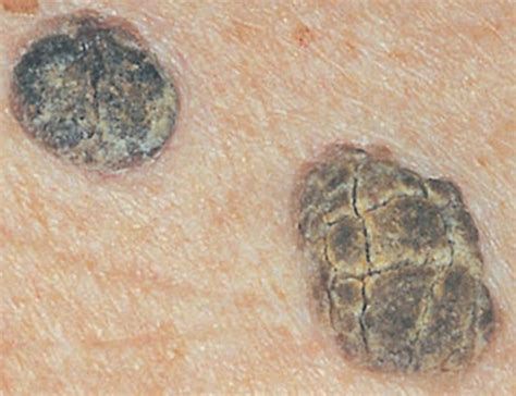 Queratosis Seborreica ClÍnica Silva