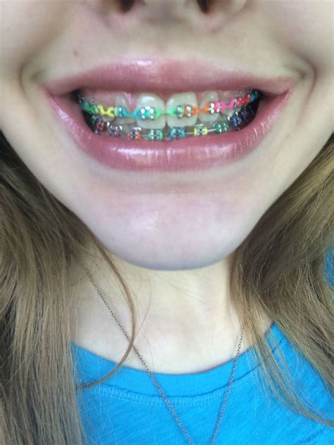 Technicolor Braces Arent They Cool Its Like Having A Rainbow Mouth Brackets Dentales