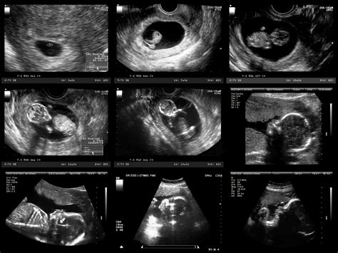 7 Week Sonograms Hiccups Pregnancy
