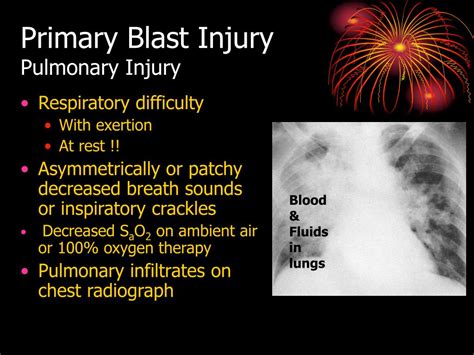 Ppt Evaluation And Treatment Of Blast Injuries Powerpoint