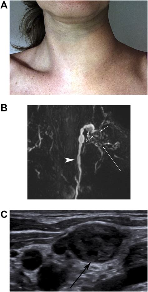 Left Cervical Swelling Due To Lymphatic Intraluminal Obstruction