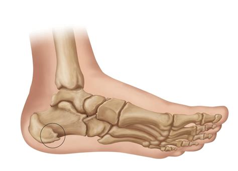 What Are Heel Spurs Learn Symptoms Causes And Treatment