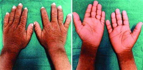 Brown Scaly Lesions Over Extensor Left And Flexor Right Aspect Of