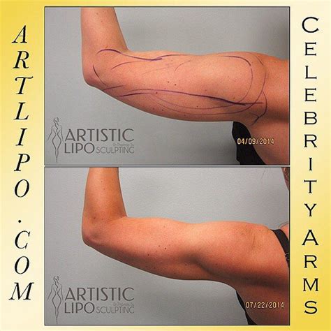 Artistic Liposculpting Center On Instagram Celebrity Arms