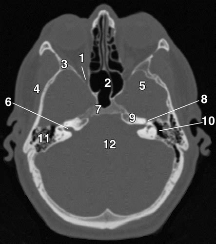 Skull Baserelated Lesions At Routine Head Ct From The Emergency