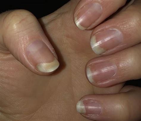 Australian Experts Reveal Common Nail Problems And What These Say About