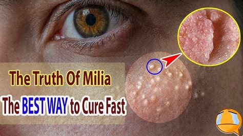 Unbelievable How I Remove All Milia By Lemon White Bumps Under Eyes