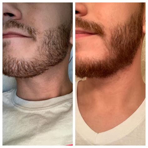 Patchy Beard Will The Patch Go Away 18 Days Vs 40 Days Patchy