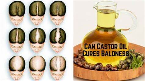 Does Castor Oil Help Treat Baldness?
