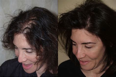 Hair Transplants For Women Photos Miami Fl Patient