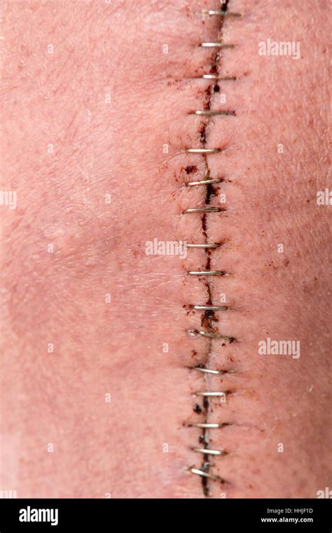 Close Up Of Large Post Knee Surgery Incision Held Together With Staples