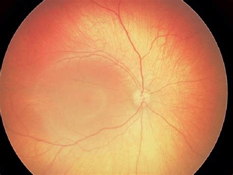 Retinal Hypopigmentation Was Seen On The Fundus Photograph Of The