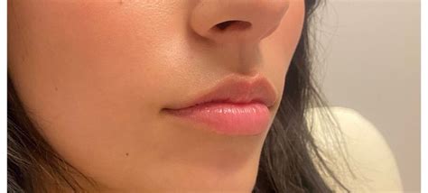 Lip Injections And Fillers In Gilbert Az Onyx Integrative