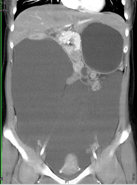 Loculated Ascites In Ovarian Cancer Obgyn Case Studies Ctisus Ct