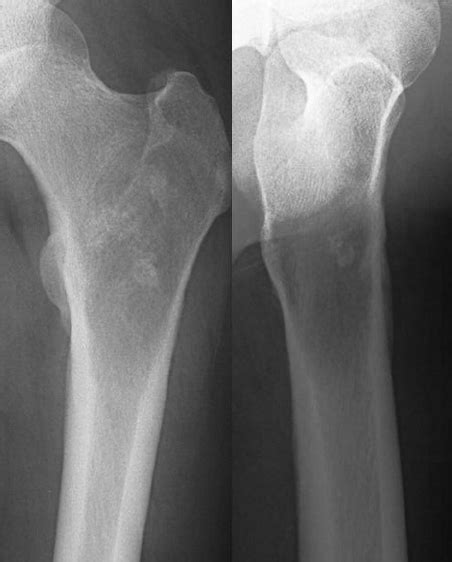 Radiographs Showing A Poorly Demarcated Osteolytic Lesion With Focal