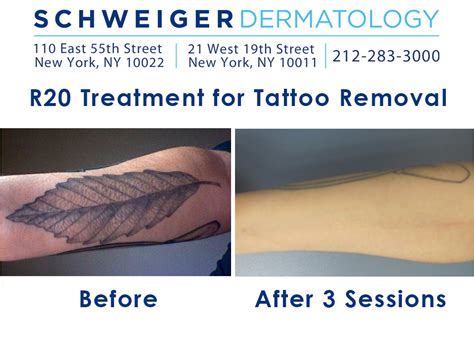 New Tattoo Removal Techniques Get Rid Of Unwanted Ink In Record Time