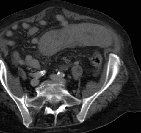 Spontaneous Intramural Jejunal Haematoma A Case Report Cases Journal