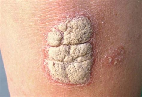 Psoriasis Vs Skin Cancer