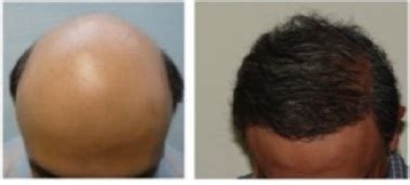 Risks and costs of treatment. Body Hair Transplant Cost - DermHair Clinic Los Angeles 1 ...