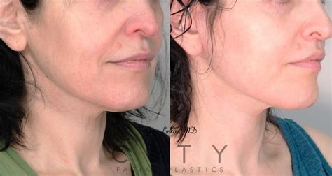 Check Out This Neck Lift Transformation By Dr Linkov