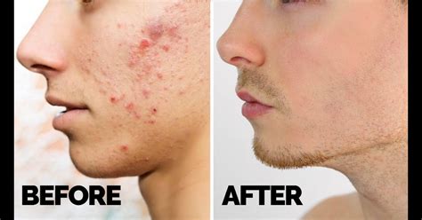 When Does Acne Go Away For Guys