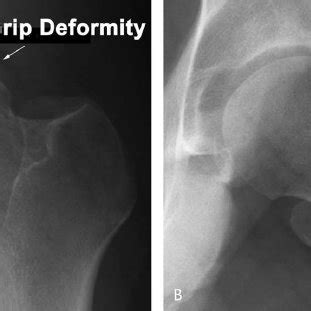 A A Pistol Grip Deformity On The Anteroposterior Radiograph Of A