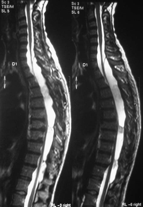 Giant Intradural Extramedullary Arachnoid Cyst Of The Thoracic Spine