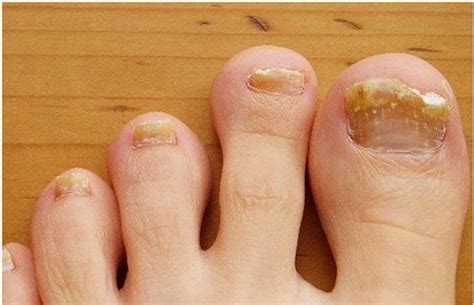 Brittle Toenails Causes Treatment And Cure Updated In 2022