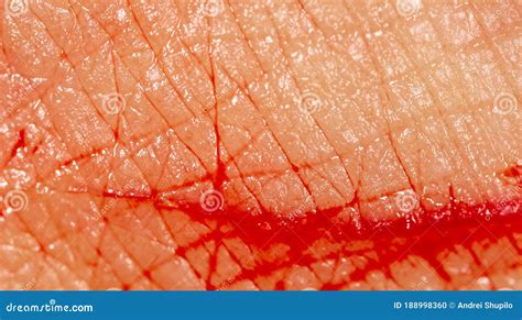 Close Up Of Blood From A Wound On A Human Skin Stock Photo Image Of