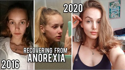 Anorexia How To Recover Youtube